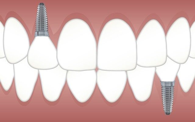 Dental Implants